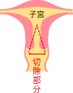 円錐切除術