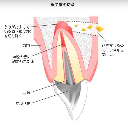 歯根端切除術