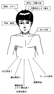 目の異物