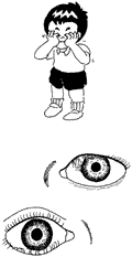 眼瞼内反症