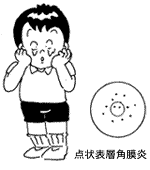 流行性角結膜炎