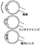 無水晶体症