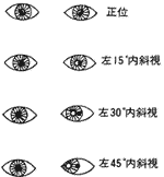 斜視