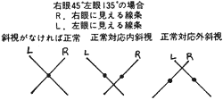 斜視