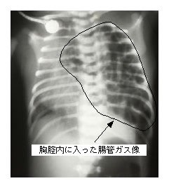 横隔膜ヘルニア