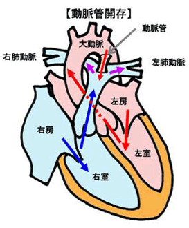 動脈管開存症