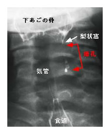 梨状窩瘻