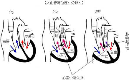 大血管転位症