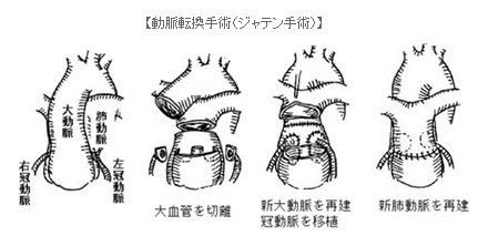 大血管転位症