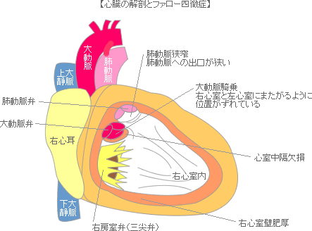 ファロー四徴症