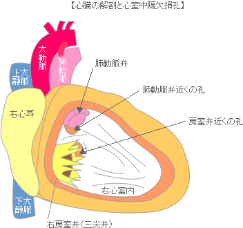 心室中隔欠損症