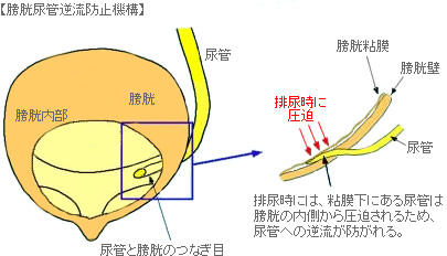 膀胱尿管逆流症