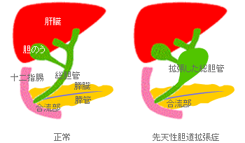 先天性胆道拡張症