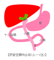 先天性胆道拡張症