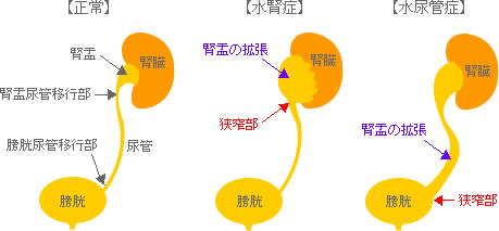 水腎症