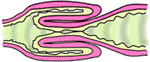 intussusception schema